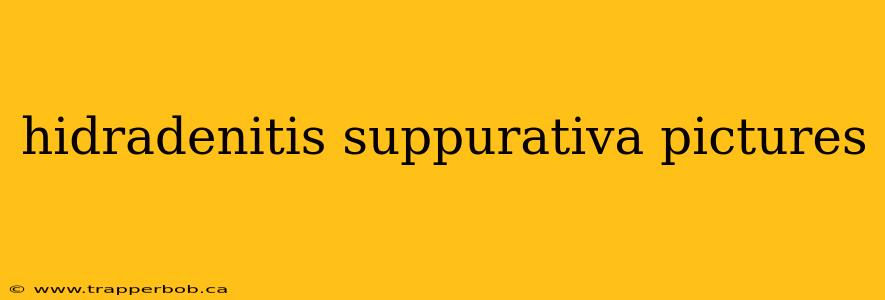 hidradenitis suppurativa pictures